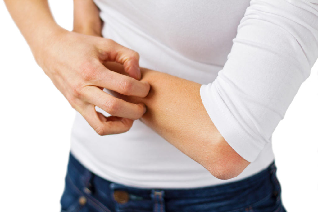 Natural Remedies for Bug Bites