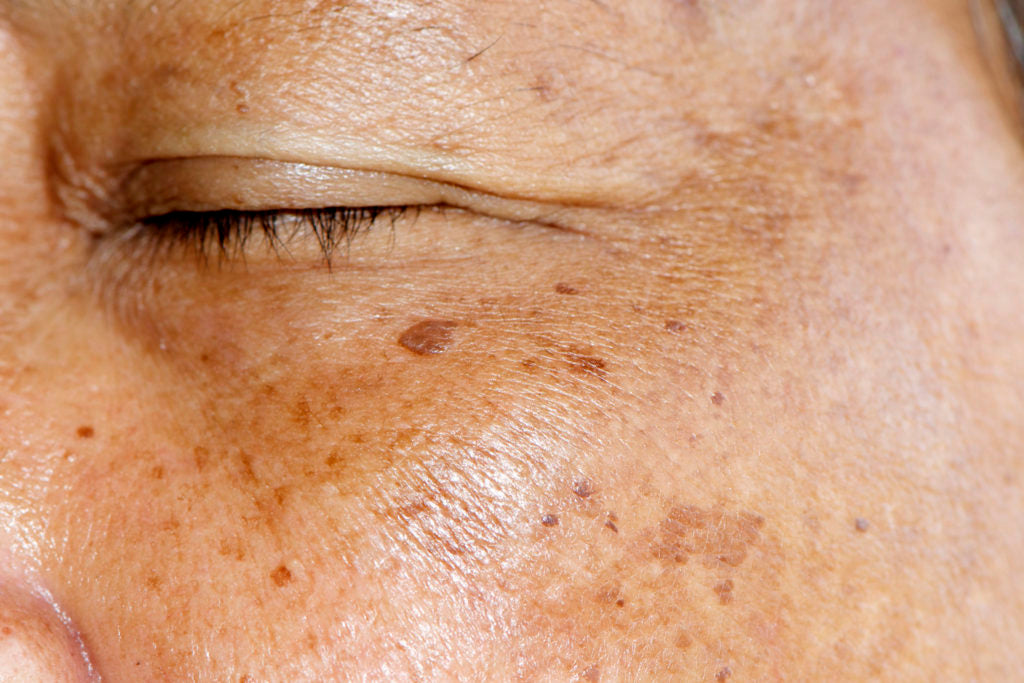 Melasma: Hormonal Dark Spots