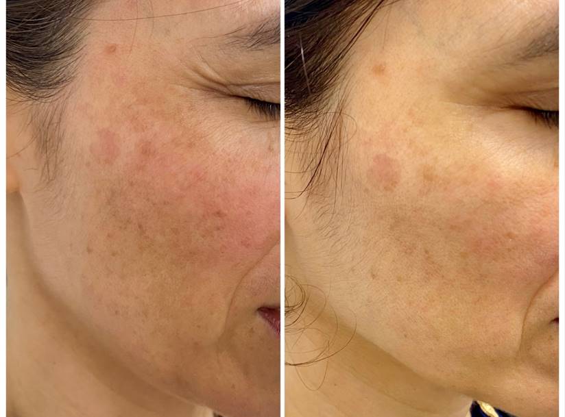 Melaclear Advanced Serum