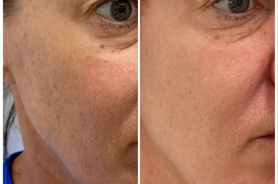 Melaclear Advanced Serum