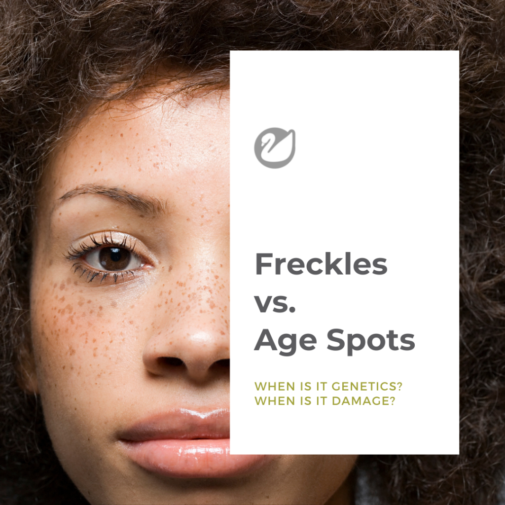 What is the difference between freckles and age spots?
