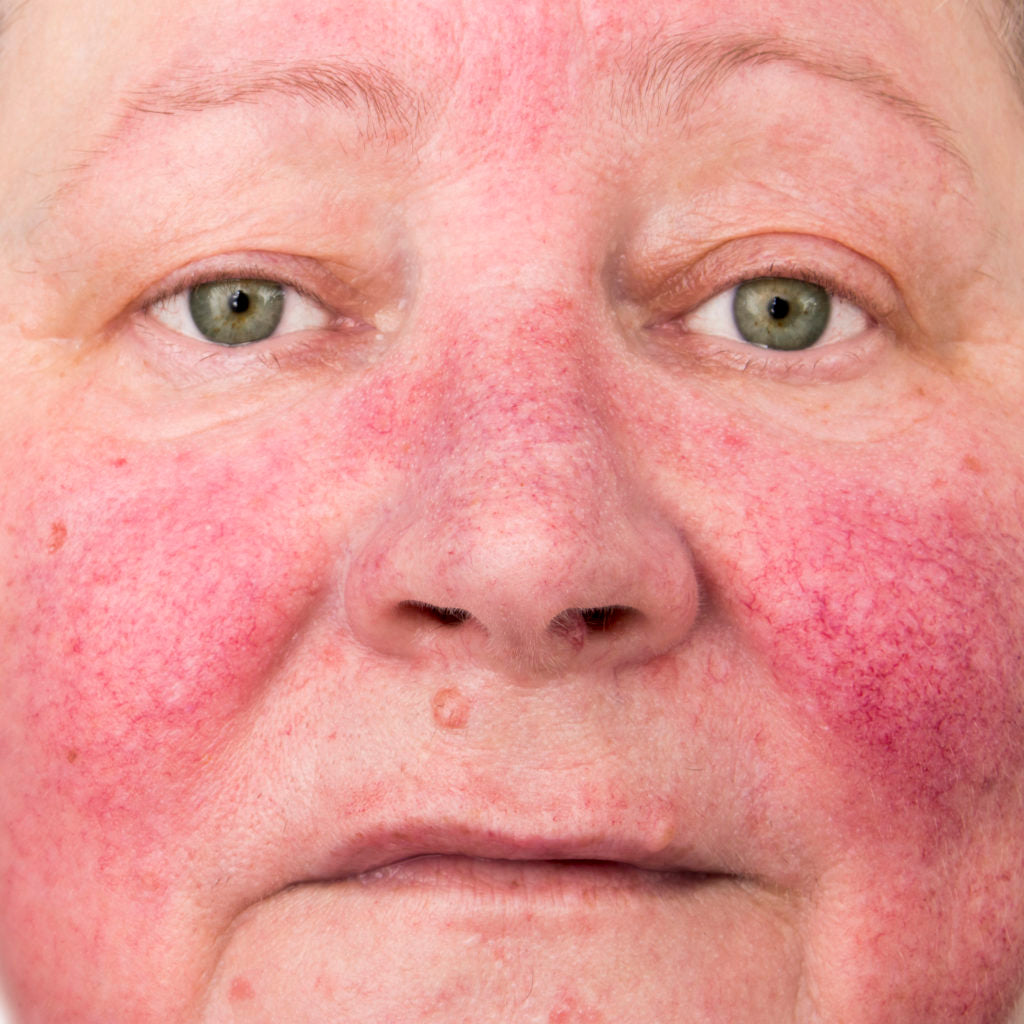What is Rosacea?