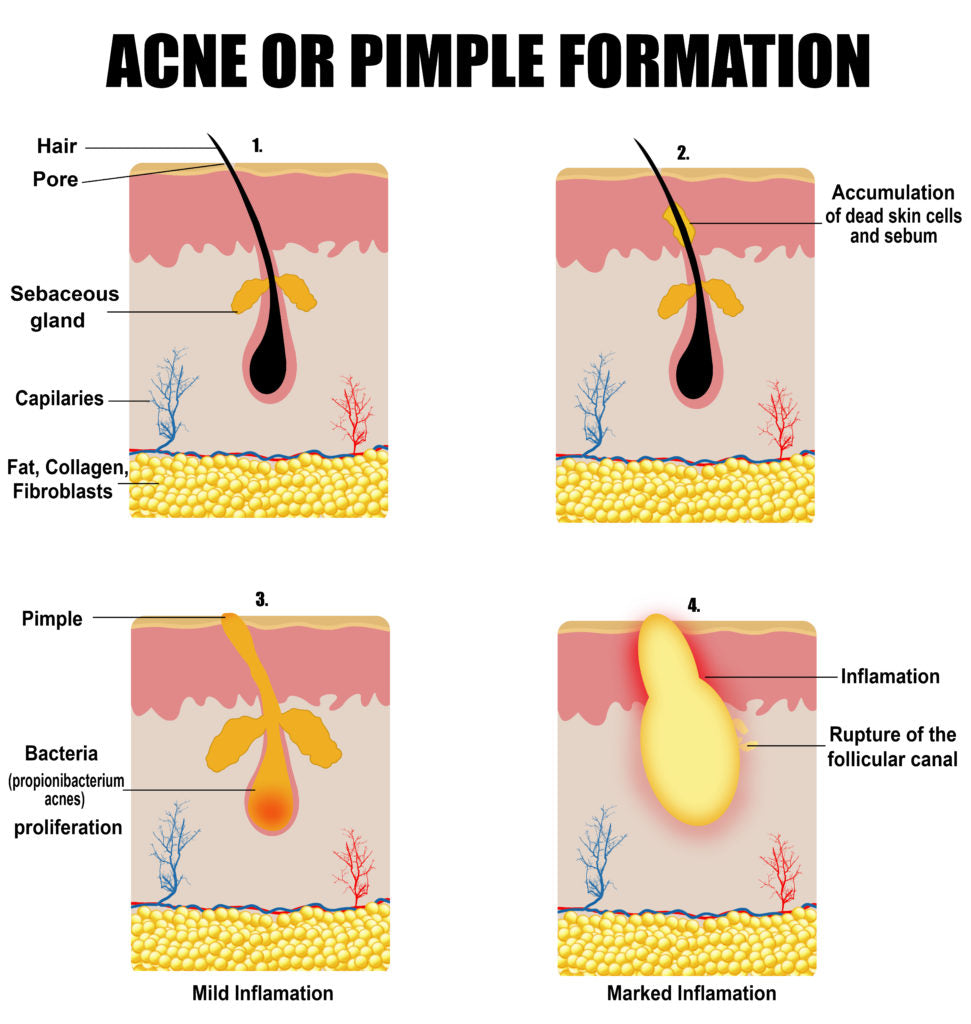 10 False Beliefs about Acne Everyone Thinks are True