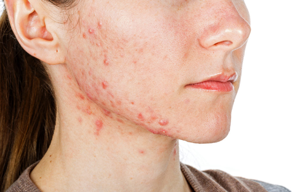 Banish Acne the Right Way: Modern Changes in Treatment